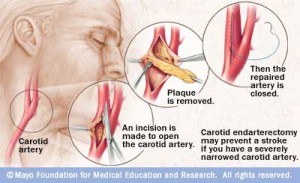 carotidendarterectomy